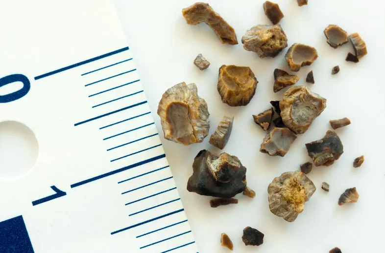Cálculos renais de vários tamanhos ao lado de uma régua