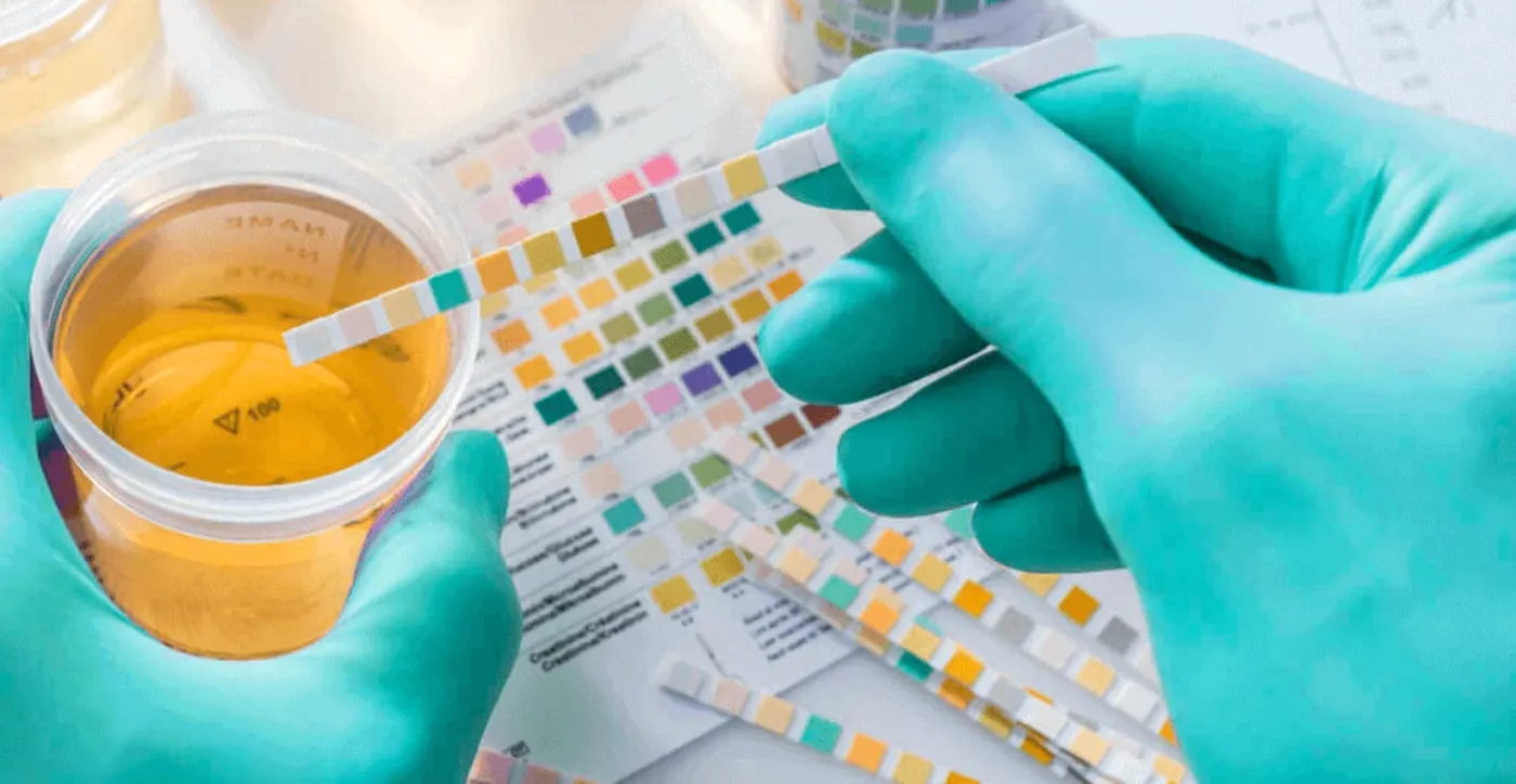 Fita reagente sendo comparada à tabela de cores de um exame de urina