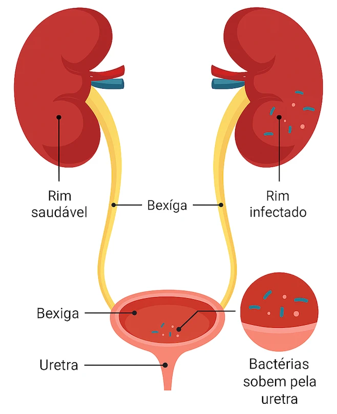 Esquema da infecção ascendente: bactérias sobem pela uretra até a bexiga e chegam ao rim infectado, comparado a um rim saudável