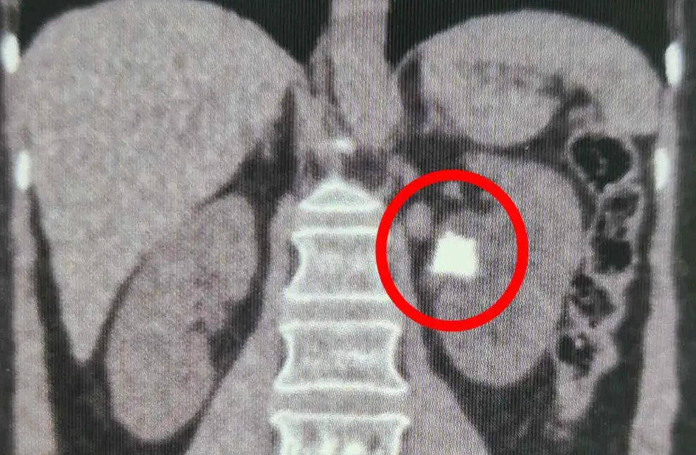 Tomografia computadorizada com um cálculo renal destacado por um círculo vermelho